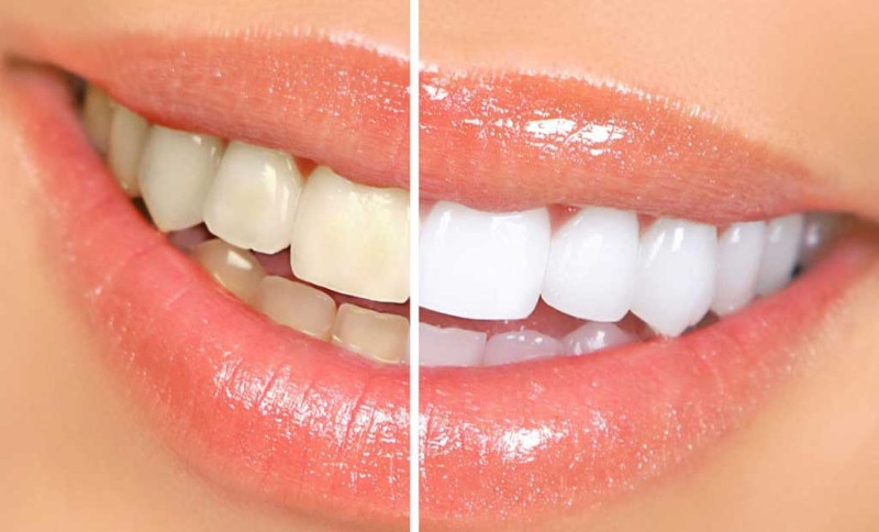 Mách bạn bí kíp giúp tẩy trắng răng tiết kiệm